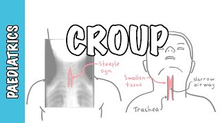 What is Croup larynotracheobronchitis  symptoms pathophysiology investigations treatment [upl. by Animsaj]