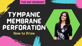 Tympanic Membrane Perforations  How to Draw [upl. by Eittik414]