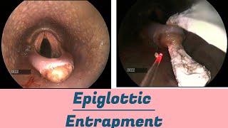 Epiglottic Entrapment [upl. by Veradis]