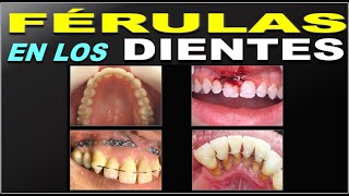 INDICACIONES Y TRATAMIENTOS CON FERULAS DENTALES FERULIZACION [upl. by Adnak]