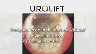 UroLift™ System Treatment [upl. by Malsi]