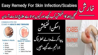 Scabies amp Skin Infection Treatment  Kharish Ka Desi Gharelu Ilaj HindiUrdu by Dr Asim [upl. by Laersi]