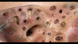 BLACKHEADS AND HIDDEN ACNE FOR THE ELDERLY [upl. by Emylee770]