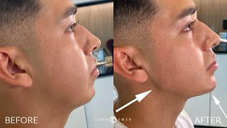 MALE FACIAL SCULPTING DEFINING THE JAWLINE AND CHIN WITH RADIESSE FILLER  DR JASON EMER [upl. by Jana]