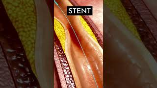 Angioplasty in 3D Animation StepbyStep Guide to Heart Health [upl. by Las268]