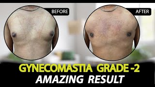 Gynecomastia Grade 2B Surgery in Jaipur  Patient Feedback  Rejuvena Cosmo Care [upl. by Basile]