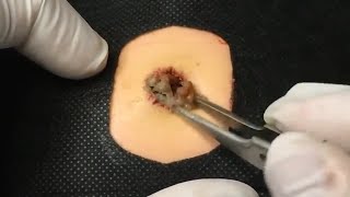 BEST Pimple Popping  Whiteheads Removal  Big Cystic Acne Blackheads  Squeezing Pimples  Tr0039 [upl. by Cassella217]