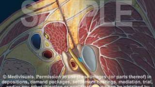 Cervical Transforaminal Epidural Injection [upl. by Anawt]