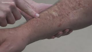 Skin Cancer How to spot melanoma warning signs [upl. by Nrol]