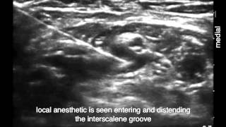 Periplexus Interscalene Brachial Plexus Block In Plane Approach [upl. by Ulyram]