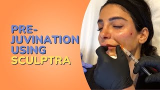 PREJUVINATION USING SCULPTRA TO BUILD COLLAGEN AND LIFT THE FACE WITHOUT FILLERS  DR JASON EMER [upl. by Geanine]