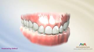 Orthodontic Treatment for Deepbite  Wire with Reverse Curve of Spee [upl. by Chrotoem]