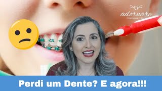 Perdi o Dente e Agora Aparelho ou Implante [upl. by Dasya]