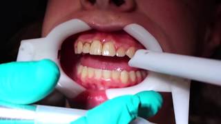 Gingival Recontouring Reshaping the gum tissue with a laser [upl. by Akla747]