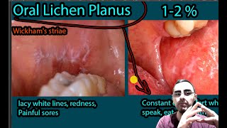 Oral Lichen Planus  Symptoms Causes Treatment Wickhams striae [upl. by Backer956]