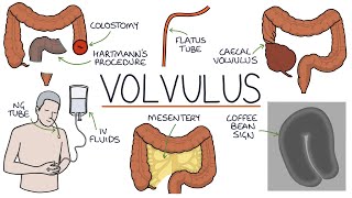 Understanding Volvulus Twisted Bowel [upl. by Bounds]