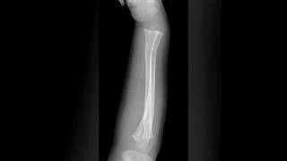 Greenstick fractures  radius and ulna shoets [upl. by Jone]