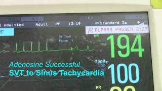 SVT or Supraventricular Tachycardia [upl. by Argyle]