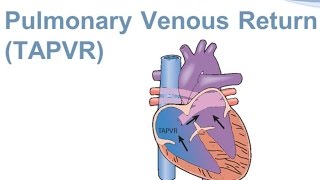 Total Anomalous Pulmonary Venous Return TAPVR [upl. by Thordis]