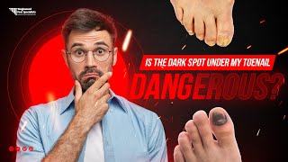 Is the Dark Spot Under My Toenail Dangerous [upl. by Notloc154]