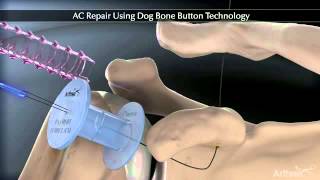 Acromioclavicular Joint repair Using Arthrex Dog Bone Button [upl. by Aronal52]