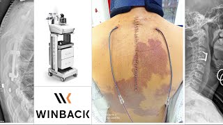 TECAR Terapia WINBACK post intervento di artrodesi  stabilizzazione vertebrale C3C4 e T3T7 [upl. by Hinch]