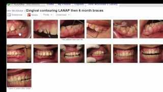 Cyclosporin Induced Gingival Hyperplasia Before and After LANAP 6 month ortho [upl. by Dail]