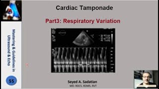 Cardiac tamponade Part 3 Respiratory Variation [upl. by Lucilla256]