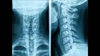 transverse process vertebral artery foramina foramen tranversarium on lateral view cervical spine [upl. by Jolene762]