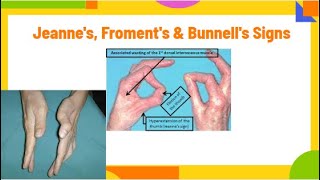 jeannes froments amp Bunnells signs  ulnar neuropathy PhysiotherapyKnowledge [upl. by Rexferd]