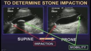 Ultrasound of the Gallbladder [upl. by Morven77]