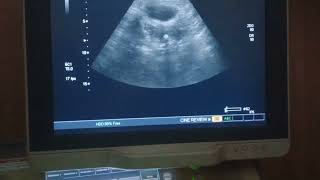 Osseous metaplasia uterus pelvicultrasound pathology [upl. by Dammahom]