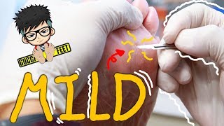 Corn Removal with Callus Mildly Satisfying [upl. by Cha]