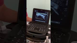 UltrasoundGuided Barbotage for Calcific Tendonitis  Kent MSK Clinic [upl. by Barstow]