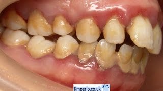 Treatment of Periodontal DiseaseBefore and After [upl. by Siegel6]