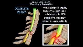 Spinal Cord Injury Complete Or Incomplete  Everything You Need To Know  Dr Nabil Ebraheim [upl. by Kalagher759]