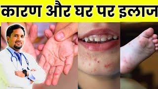 बच्चों के हाथ पैरों मुँह पर निकलने वाले दाने Hand foot mouth disease [upl. by Eidolem]