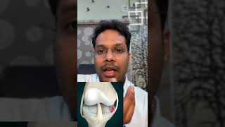 Knee pain  Bakers cyst  Telugu kneepain osteoarthritis shorts [upl. by Schaffer]