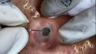 Big Cystic Acne Blackheads Extraction Blackheads amp Milia Whiteheads Removal Pimple Popping 094 [upl. by Locke]