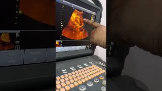 বাচ্চাদের আল্ট্রাসনগ্রাফি কীভাবে করি॥Ultrasonography of Children॥USG of whole abdomen॥Anatomy॥শিশু॥ [upl. by Worthington301]