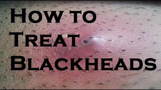 How to treat blackheads [upl. by Nilra132]