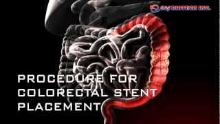 Colorectal Stent [upl. by Ennairoc]