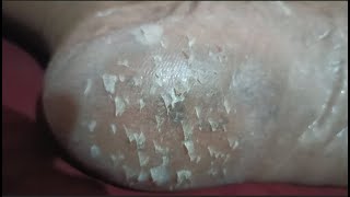 cleansing the skin of the soles of the feet  Removal Callus [upl. by Nolla]