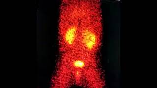 DTPA Scan showing right PUJ Obstruction [upl. by Htelimay958]