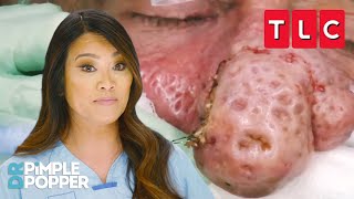 Bumpiest Nose Growths  Dr Pimple Popper  TLC [upl. by Adamson]