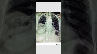 Lung abscess  cavity lesion [upl. by Faustina595]