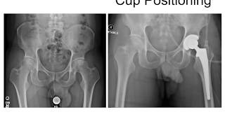 Cup Positioning and Anatomic Restoration Using Fluoroscopy in the Direct Anterior Approach [upl. by Jedd]