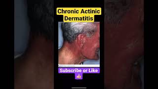 Chronic Actinic Dermatitis [upl. by Edelman]