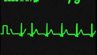 Accelerated Nodal Rhythm  ECG Simulator  Arrhythmia Simulator [upl. by Boffa]