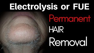 Part 2 Electrolysis Hair Removal White hair [upl. by Airemahs]